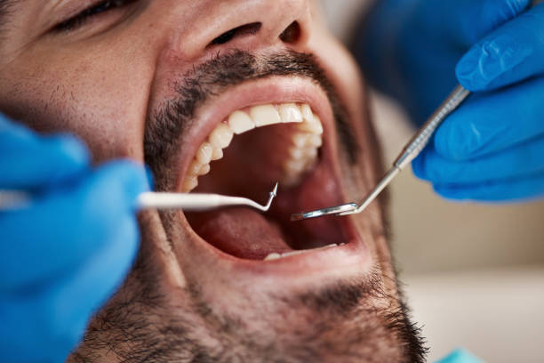 Best Emergency Wisdom Teeth Removal in Lima, OH